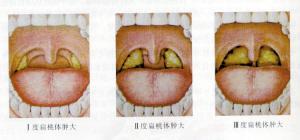 扁桃体炎有哪些临床症状表现